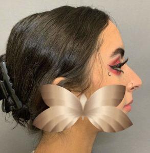 Before Image: Rhinoplasty and Chin Implant by Dr. Henstrom