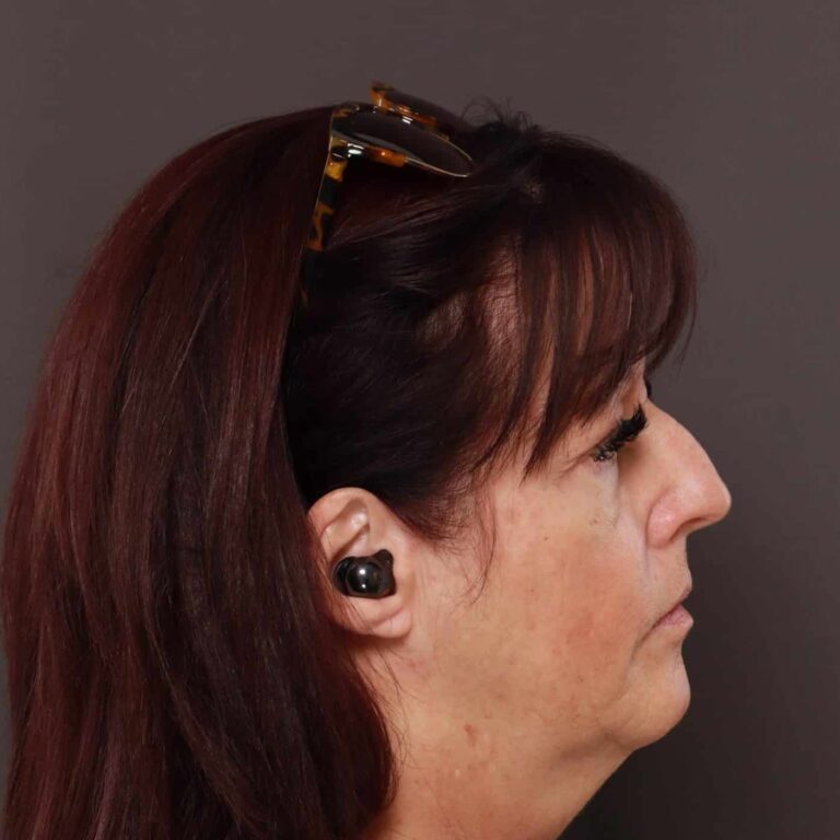 Before Image: Rhinoplasty/Septoplasty by: Dr. Thompson - right-side