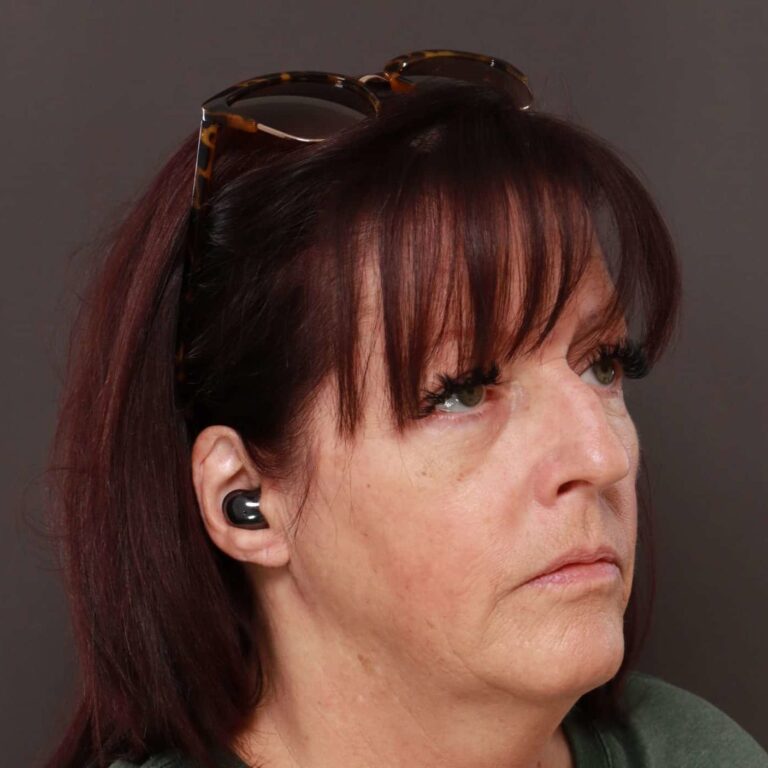 Before Image: Rhinoplasty/Septoplasty by: Dr. Thompson - right-front-oblique