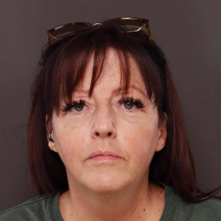 Before Image: Rhinoplasty/Septoplasty by: Dr. Thompson - front