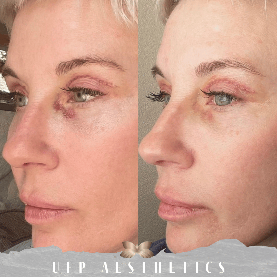 3 days post eyelid surgery, 24 hours between BBL treatment BBL Bruising