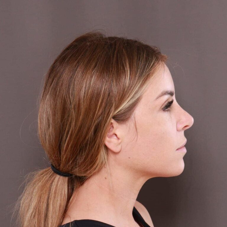 After Image: Rhinoplasty by: Dr. Henstrom - right-side