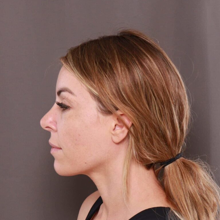 After Image: Rhinoplasty by: Dr. Henstrom - left-side