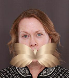 Before Image: Facelift, Upper Eyelid Lift, Lower Skin Pinch and Fat Grafting by: Dr. Thompson