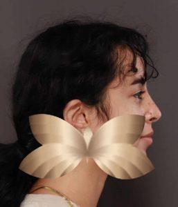 After Image: Rhinoplasty and Chin Implant by Dr. Henstrom