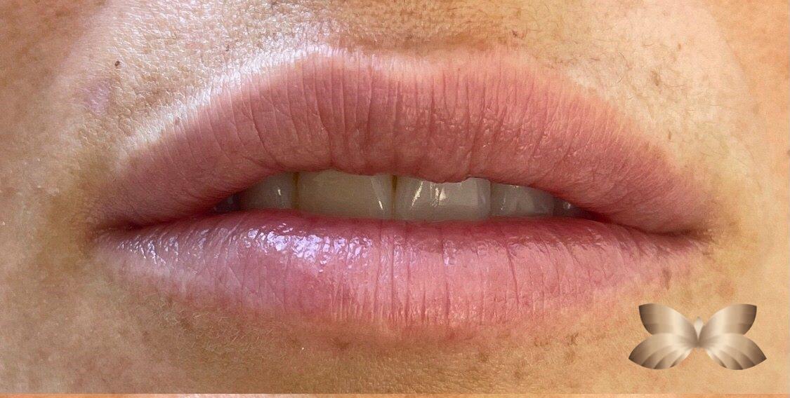 Lip Augmentation by UFP Nurse Injector