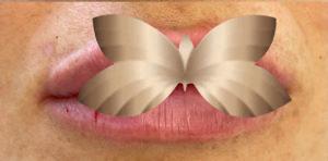 After Image: Lip Augmentation by UFP Nurse Injector