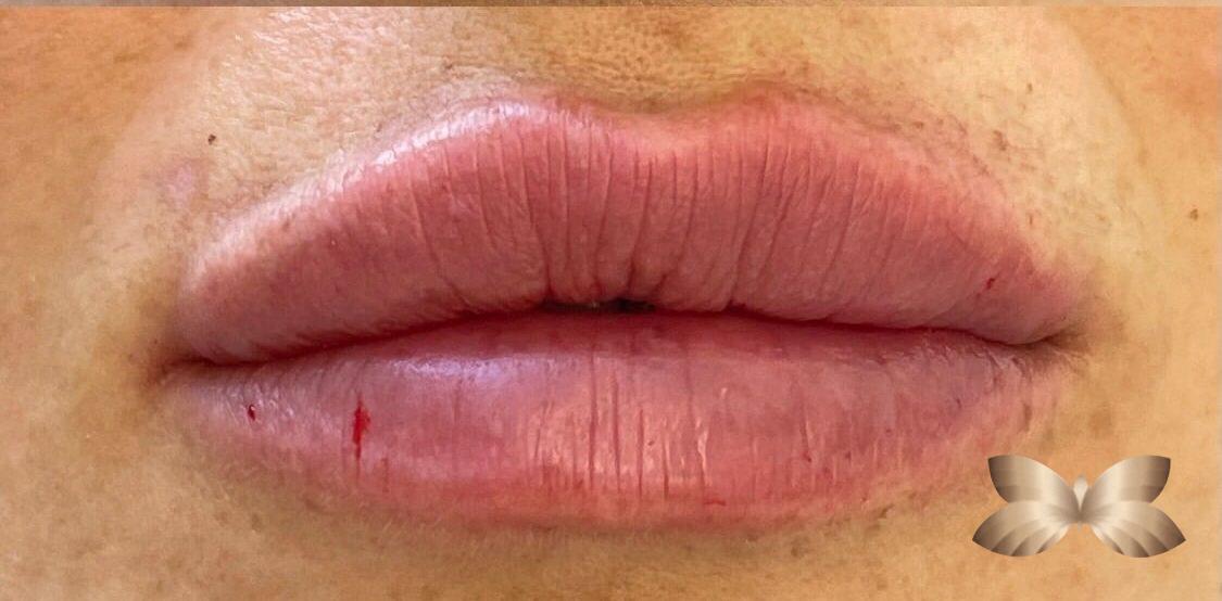 Lip Enhancement Archives Utah Facial Plastics