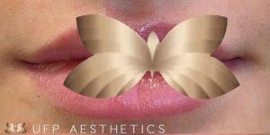 Before Image: Lip Augmentation by: UFP Nurse Injector