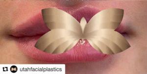 After Image: Lip Augmentation by: UFP Nurse Injector