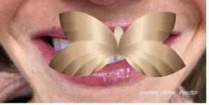 After Image: Lip Augmentation by: Jeanna