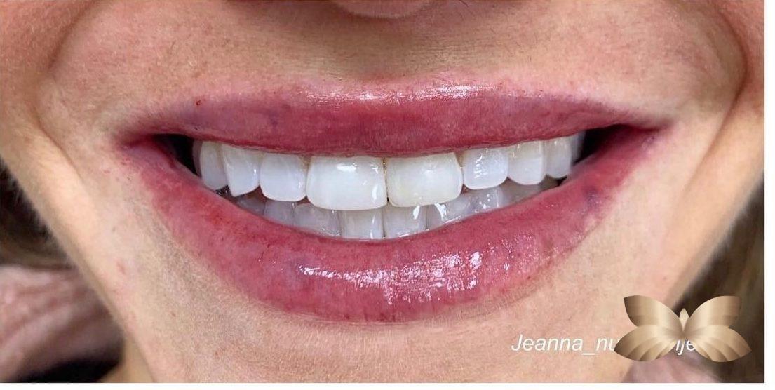 Lip Augmentation by Nurse Injector Jeanna Utah Facial Plastics