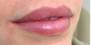 Before Image: Lip Augmentation By: Jeanna