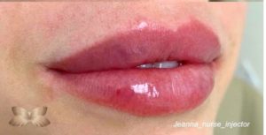 After Image: Lip Augmentation By: Jeanna