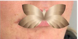 Before Image: Lip Augmentation by: Nurse Injector Jeanna