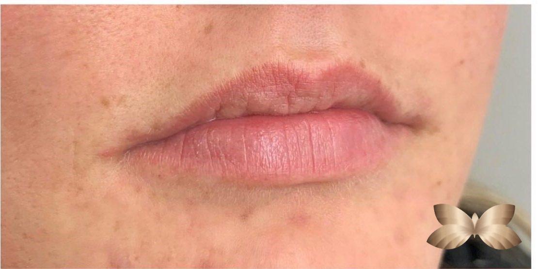 Lip Augmentation By UFP Nurse Injector Utah Facial Plastics