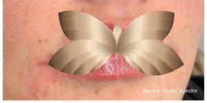 After Image: Lip Augmentation by: Nurse Injector Jeanna