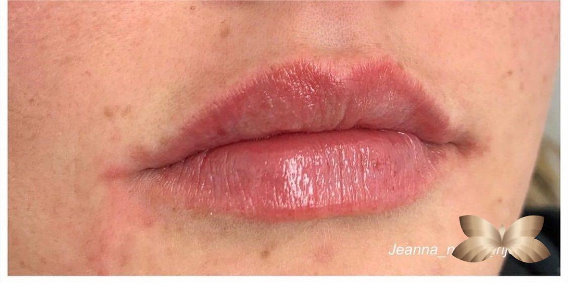 Lip Augmentation by: Nurse Injector Jeanna