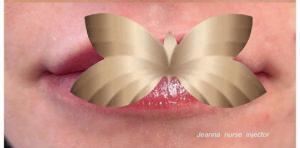 Aumento de labios por: Jeanna