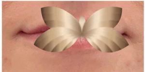 Before Image: Lip Augmentation by: Jeanna