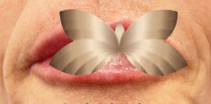 After Image: Lip Augmentation by: Sarah