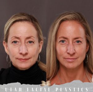 UFP Eyelid Lift UFP Eyelid Lift