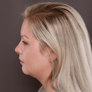 chin lipo after after Neck & Chin Liposuction Salt Lake City UT