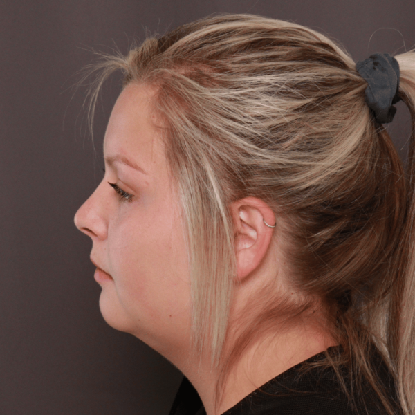 chin lipo before before Neck & Chin Liposuction Salt Lake City UT