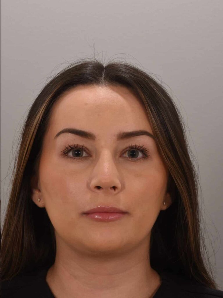 After Image: Rhinoplasty Dr. Manning - front