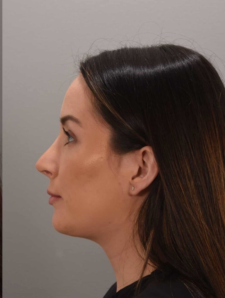 After Image: Rhinoplasty Dr. Manning - left-side