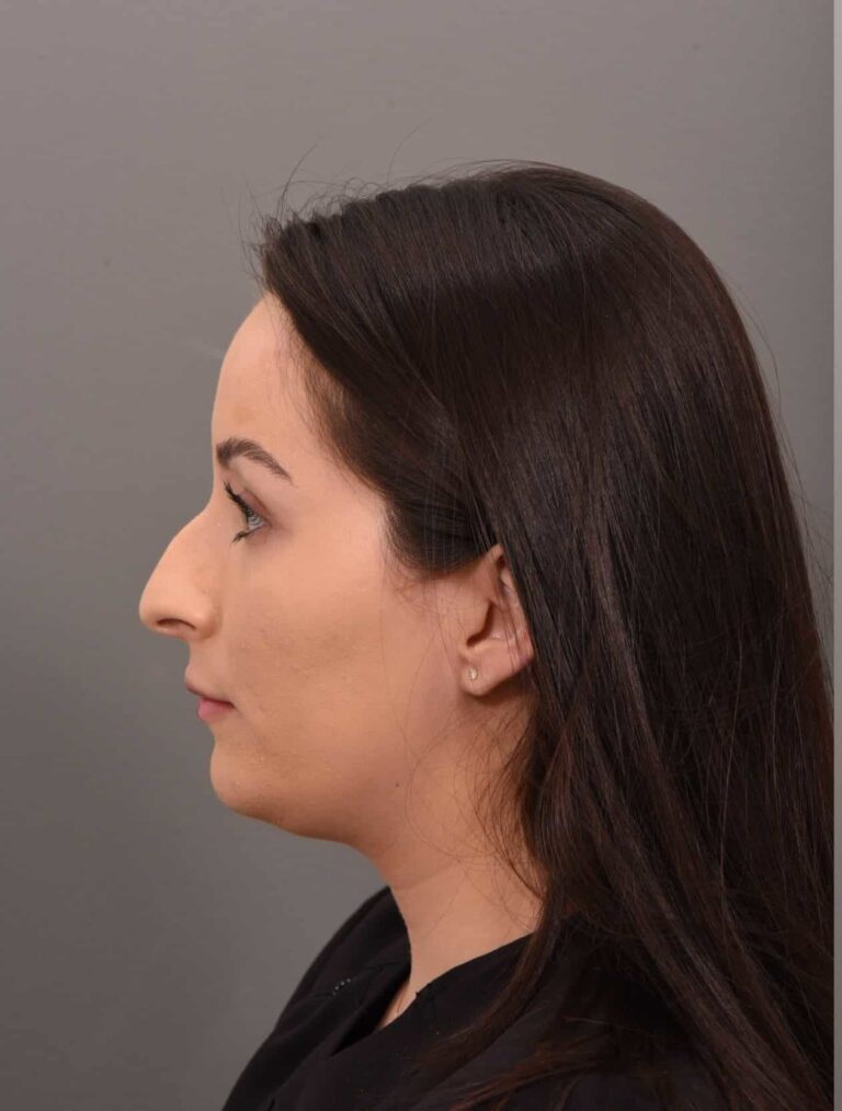 Before Image: Rhinoplasty Dr. Manning - left-side