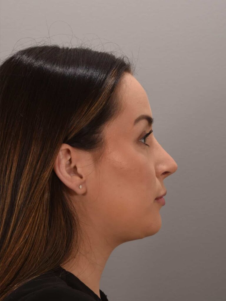 After Image: Rhinoplasty Dr. Manning - right-side