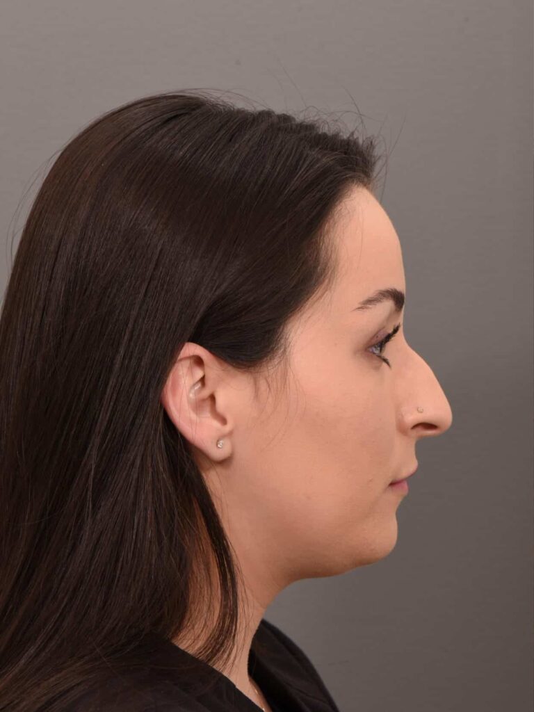 Before Image: Rhinoplasty Dr. Manning - right-side