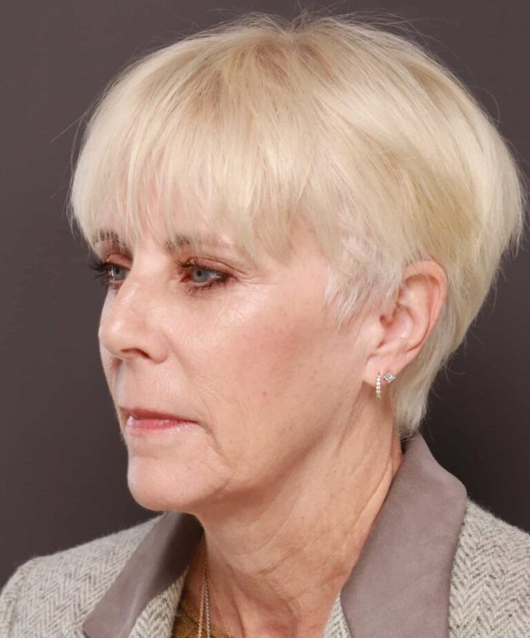 Before Image: Facelift by Dr. Henstrom - left-front-oblique