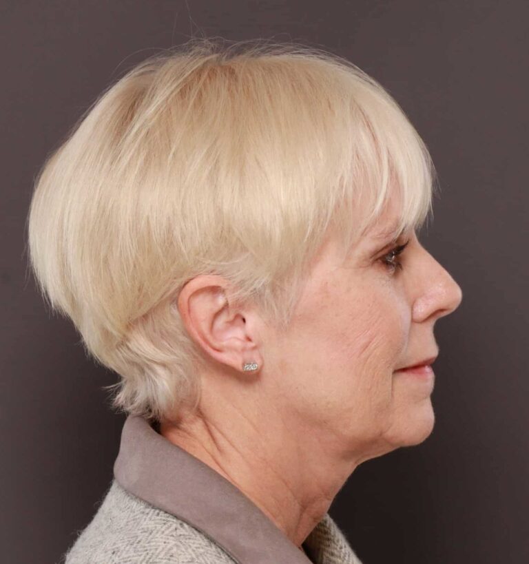 Before Image: Facelift by Dr. Henstrom - right-side