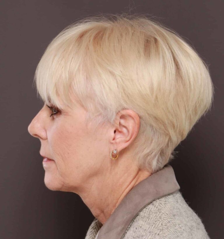 Before Image: Facelift by Dr. Henstrom - left-side