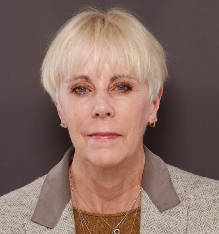Before Image: Facelift by Dr. Henstrom - front