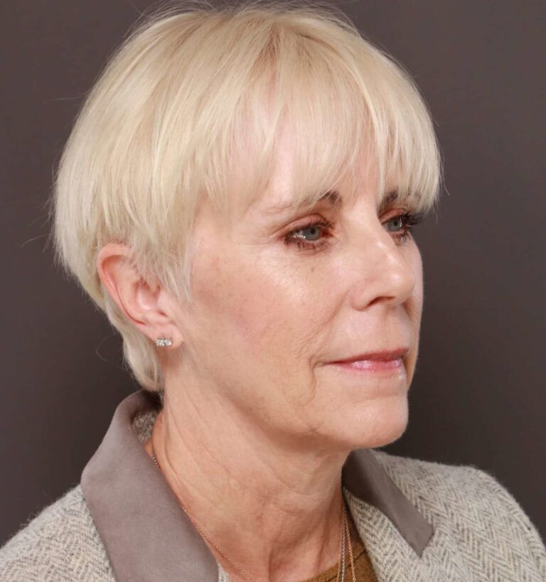 Before Image: Facelift by Dr. Henstrom - right-front-oblique