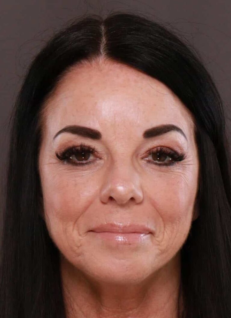 Before Image: TRL Laser Resurfacing by: Katy - front