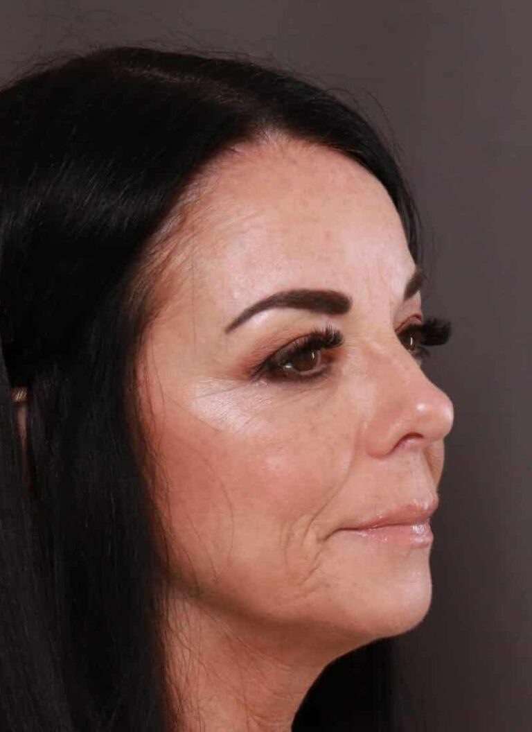 Before Image: TRL Laser Resurfacing by: Katy - right-front-oblique