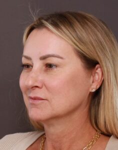 Halo Laser Resurfacing by: Katy