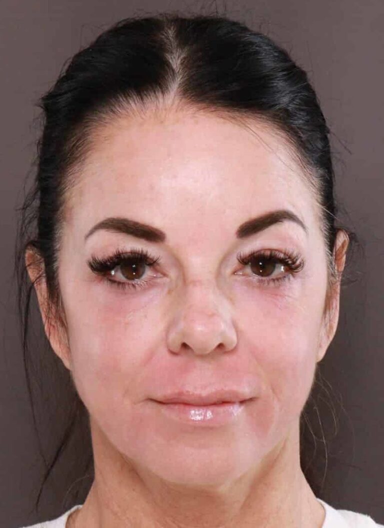 After Image: TRL Laser Resurfacing by: Katy - front