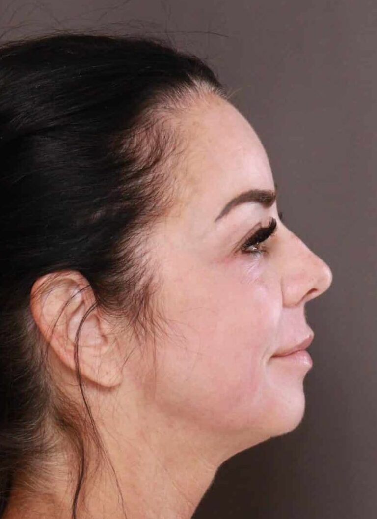 After Image: TRL Laser Resurfacing by: Katy - right-side