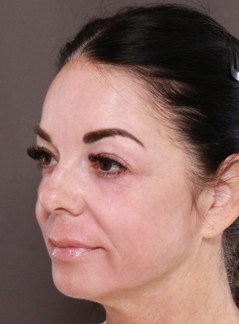 After Image: TRL Laser Resurfacing by: Katy - left-front-oblique