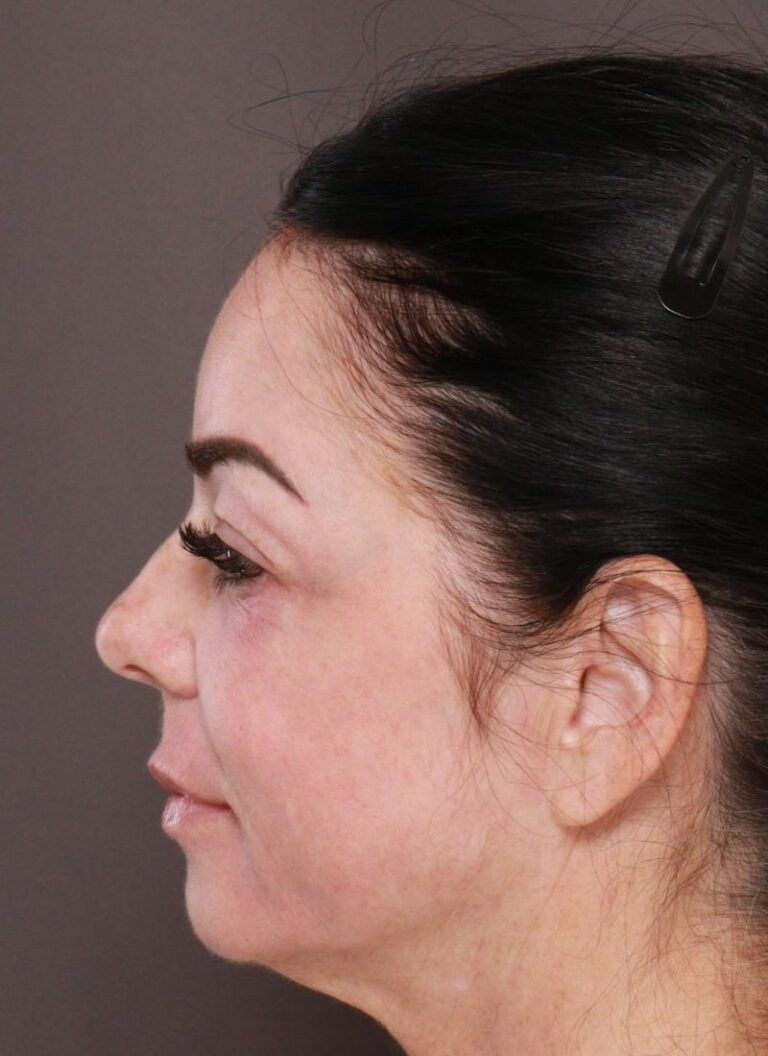 After Image: TRL Laser Resurfacing by: Katy - left-side