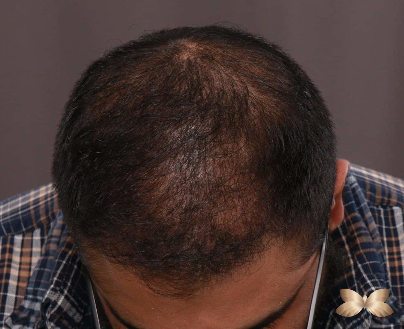 FUT Hair Restoration by: Dr. Thompson