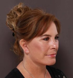 After Image: Facelift and VI Peel by: Dr. Thompson