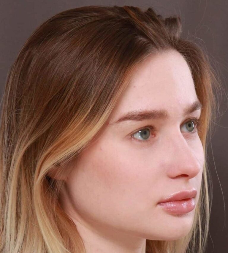 After Image: Septorhinoplasty by: Dr. Thompson - right-front-oblique