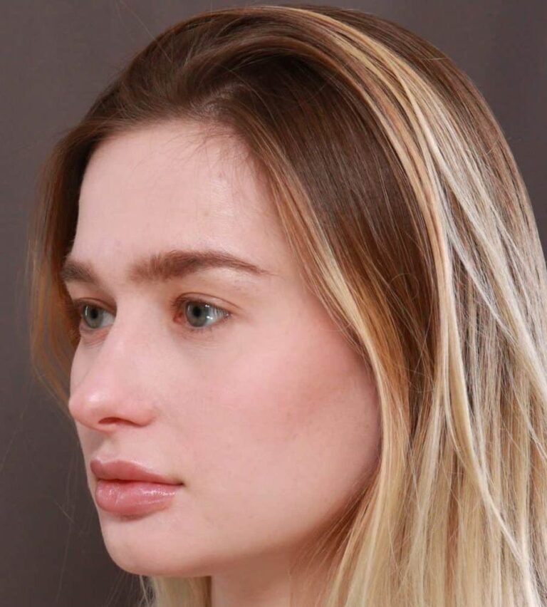 After Image: Septorhinoplasty by: Dr. Thompson - left-front-oblique