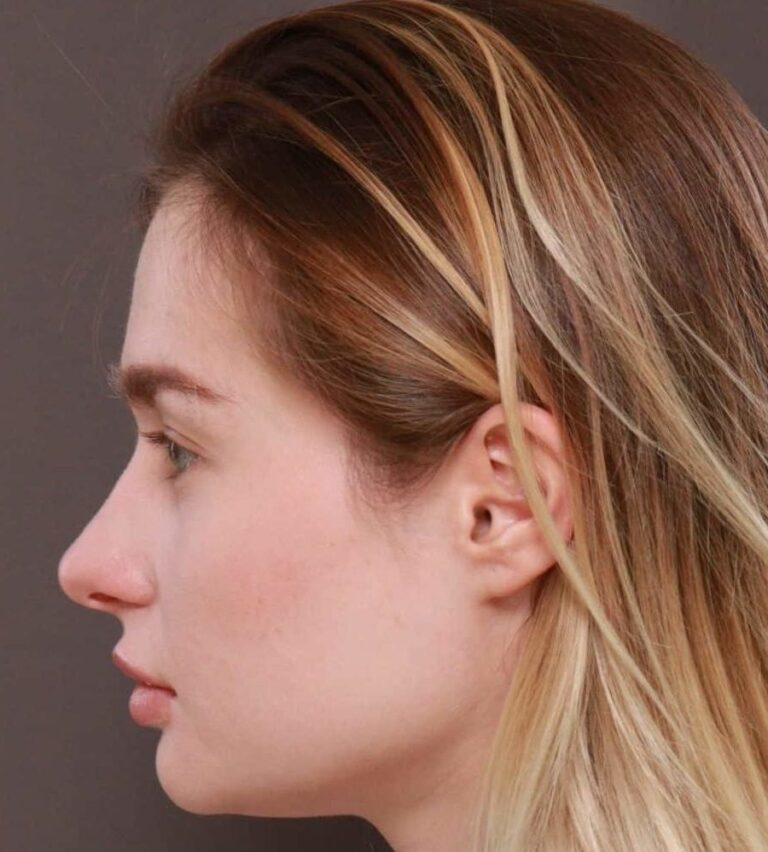 After Image: Septorhinoplasty by: Dr. Thompson - left-side